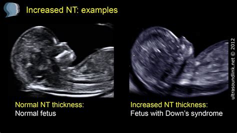 Nuchal translucency scan cost qld  However, we try to organise your appointment for between 12 weeks and 13 weeks 2 days